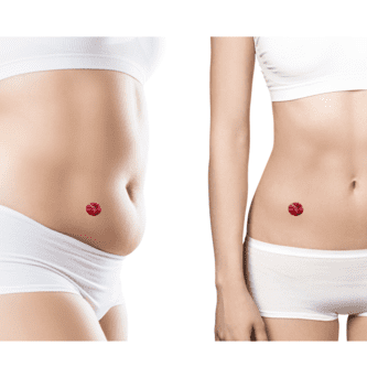 Imagen 1_hernia ostomia (1) hernia ostomía