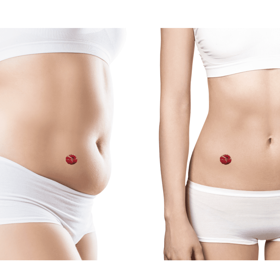 hernia-ostomía hernia ostomía